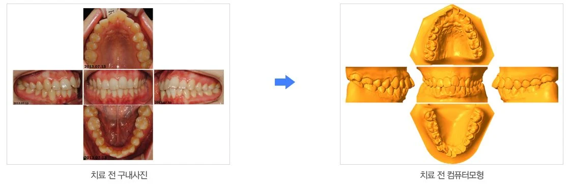 치료 전 구내사진 다섯 컷과 이를 3D 컴퓨터 모형으로 변환한 결과를 나란히 배치한 도해