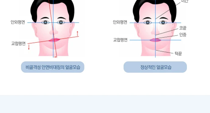 정면 얼굴에서 좌우 균형과 기울기를 표시한 안면비대칭 분석 도해