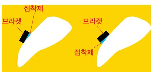 치아의 틀어진 각도에 따라 브라켓 위치와 접착제 두께가 달라지는 방식을 나타낸 일러스트