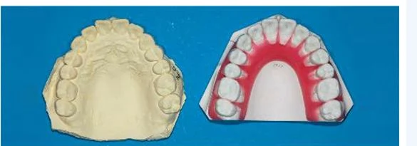 석고 모형과 3차원 입체교정으로 예상되는 가상 모형을 나란히 촬영한 사진