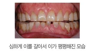 이갈이로 앞니 끝이 평평하게 닳은 구강 내 상태를 촬영한 사진