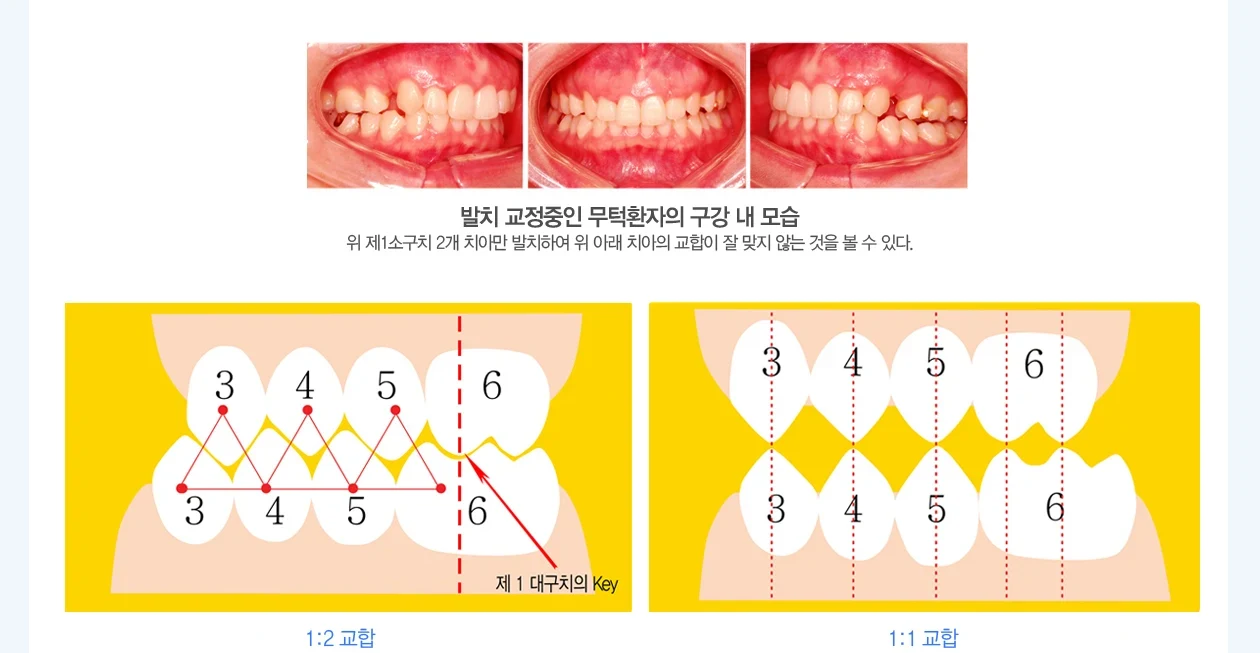 무턱에서 관찰되는 앞니 교합 상태와 좁은 악궁 형태 도해