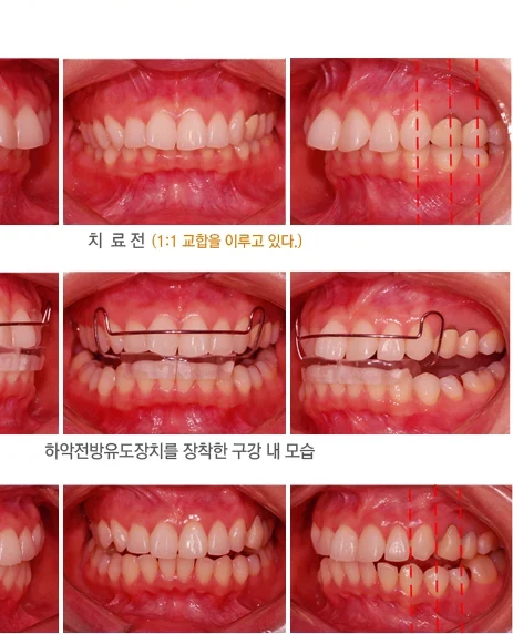 교정 치료 경과에 따른 앞니 교합 변화를 나열한 구내 사진