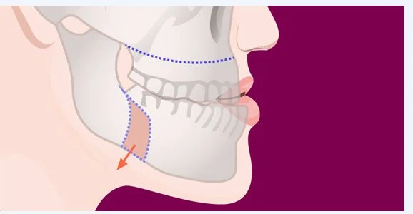 얼굴 측면에서 위턱뼈와 아래턱뼈의 절단선과 이동 방향을 점선과 화살표로 표시한 해부 일러스트