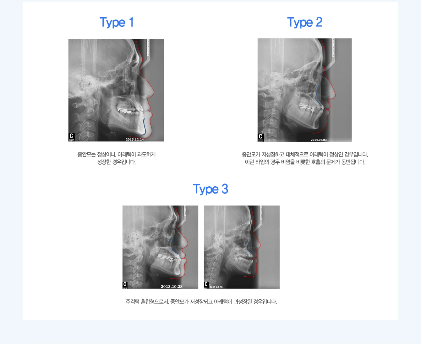 주걱턱 유형별 측면 두부 방사선 사진 — Type 1·2·3 비교