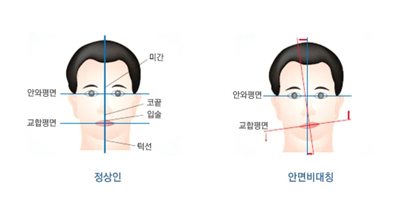 정면 얼굴의 좌우 기준선과 기울기를 표시한 균형 분석 도해