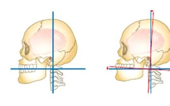 두개골과 경추의 측면 도해 두 컷으로 머리 위치가 앞뒤로 달라지는 상태를 비교한 그림