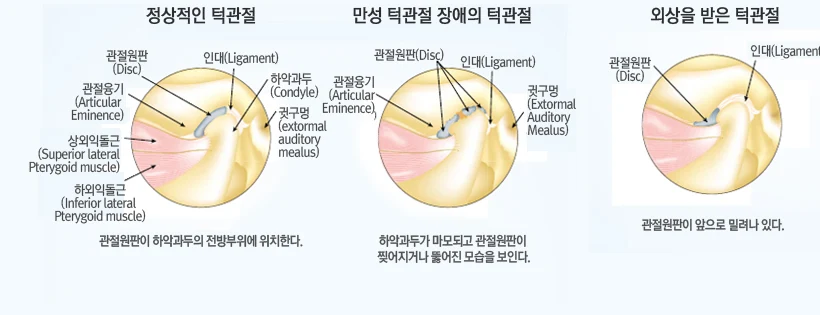 입을 벌리고 다물 때 관절원판이 움직이는 과정을 나타낸 도해