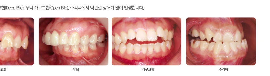 교합 상태가 서로 다른 네 가지 앞니 구내 사진 비교