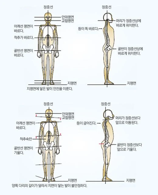 정상 자세와 척추가 휘어진 자세를 정면·측면 전신 골격 도해 네 컷으로 비교한 그림
