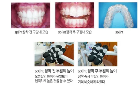 턱관절 치료에 사용하는 장치와 착용 상태를 보여 주는 도해