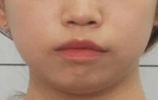 안면비대칭 치료 후 01-4 — 바른턱얼굴치과의원 실제 치료사례 비교 사진
