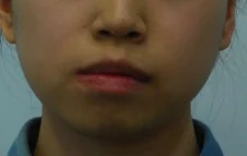 안면비대칭 치료 전 01-4 — 바른턱얼굴치과의원 실제 치료사례 비교 사진