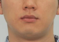 안면비대칭 치료 후 02-4 — 바른턱얼굴치과의원 실제 치료사례 비교 사진