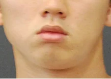안면비대칭 치료 전 02-4 — 바른턱얼굴치과의원 실제 치료사례 비교 사진