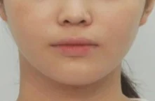안면비대칭 치료 후 04-4 — 바른턱얼굴치과의원 실제 치료사례 비교 사진