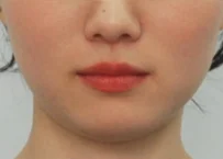 안면비대칭 치료 후 05-4 — 바른턱얼굴치과의원 실제 치료사례 비교 사진