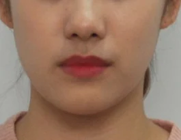 안면비대칭 치료 후 06-4 — 바른턱얼굴치과의원 실제 치료사례 비교 사진