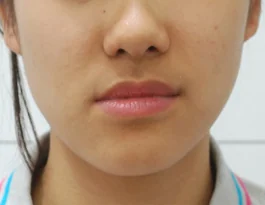 안면비대칭 치료 전 06-4 — 바른턱얼굴치과의원 실제 치료사례 비교 사진