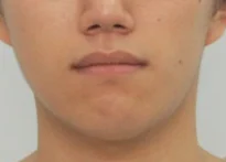 안면비대칭 치료 후 07-4 — 바른턱얼굴치과의원 실제 치료사례 비교 사진