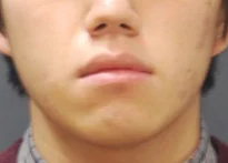 안면비대칭 치료 전 07-4 — 바른턱얼굴치과의원 실제 치료사례 비교 사진