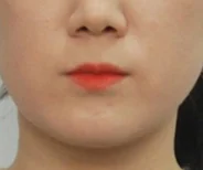 안면비대칭 치료 후 08-4 — 바른턱얼굴치과의원 실제 치료사례 비교 사진