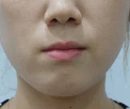 안면비대칭 치료 전 08-4 — 바른턱얼굴치과의원 실제 치료사례 비교 사진