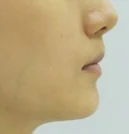 무턱 치료 후 01-4 — 바른턱얼굴치과의원 실제 치료사례 비교 사진