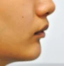 무턱 치료 전 01-4 — 바른턱얼굴치과의원 실제 치료사례 비교 사진