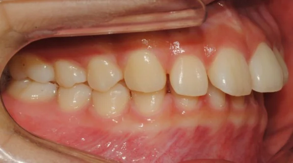 과개교합 치료 전 03-1 — 바른턱얼굴치과의원 실제 치료사례 비교 사진
