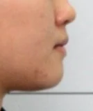 주걱턱 치료 후 01-4 — 바른턱얼굴치과의원 실제 치료사례 비교 사진