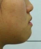 주걱턱 치료 전 01-4 — 바른턱얼굴치과의원 실제 치료사례 비교 사진
