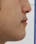 주걱턱 치료 후 02-4 — 바른턱얼굴치과의원 실제 치료사례 비교 사진