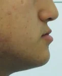 주걱턱 치료 전 02-4 — 바른턱얼굴치과의원 실제 치료사례 비교 사진