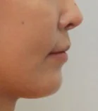 주걱턱 치료 후 03-4 — 바른턱얼굴치과의원 실제 치료사례 비교 사진