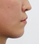 주걱턱 치료 전 03-4 — 바른턱얼굴치과의원 실제 치료사례 비교 사진