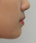 주걱턱 치료 후 04-4 — 바른턱얼굴치과의원 실제 치료사례 비교 사진