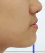 주걱턱 치료 전 04-4 — 바른턱얼굴치과의원 실제 치료사례 비교 사진