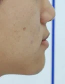 주걱턱 치료 전 05-4 — 바른턱얼굴치과의원 실제 치료사례 비교 사진