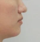 주걱턱 치료 후 06-4 — 바른턱얼굴치과의원 실제 치료사례 비교 사진
