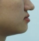 주걱턱 치료 전 06-4 — 바른턱얼굴치과의원 실제 치료사례 비교 사진