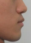 주걱턱 치료 후 07-4 — 바른턱얼굴치과의원 실제 치료사례 비교 사진