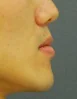 주걱턱 치료 전 08-4 — 바른턱얼굴치과의원 실제 치료사례 비교 사진