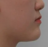 주걱턱 치료 후 09-4 — 바른턱얼굴치과의원 실제 치료사례 비교 사진