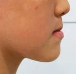 주걱턱 치료 전 09-4 — 바른턱얼굴치과의원 실제 치료사례 비교 사진