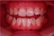 개구교합 치료 전 10-2 — 바른턱얼굴치과의원 실제 치료사례 비교 사진