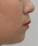 돌출입 치료 후 01-4 — 바른턱얼굴치과의원 실제 치료사례 비교 사진
