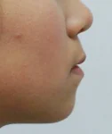 돌출입 치료 전 01-4 — 바른턱얼굴치과의원 실제 치료사례 비교 사진