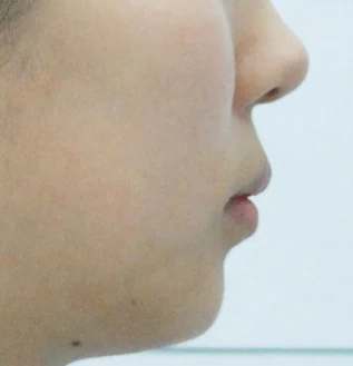 돌출입 치료 후 02-4 — 바른턱얼굴치과의원 실제 치료사례 비교 사진