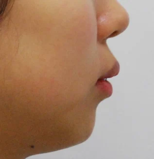 돌출입 치료 전 02-4 — 바른턱얼굴치과의원 실제 치료사례 비교 사진